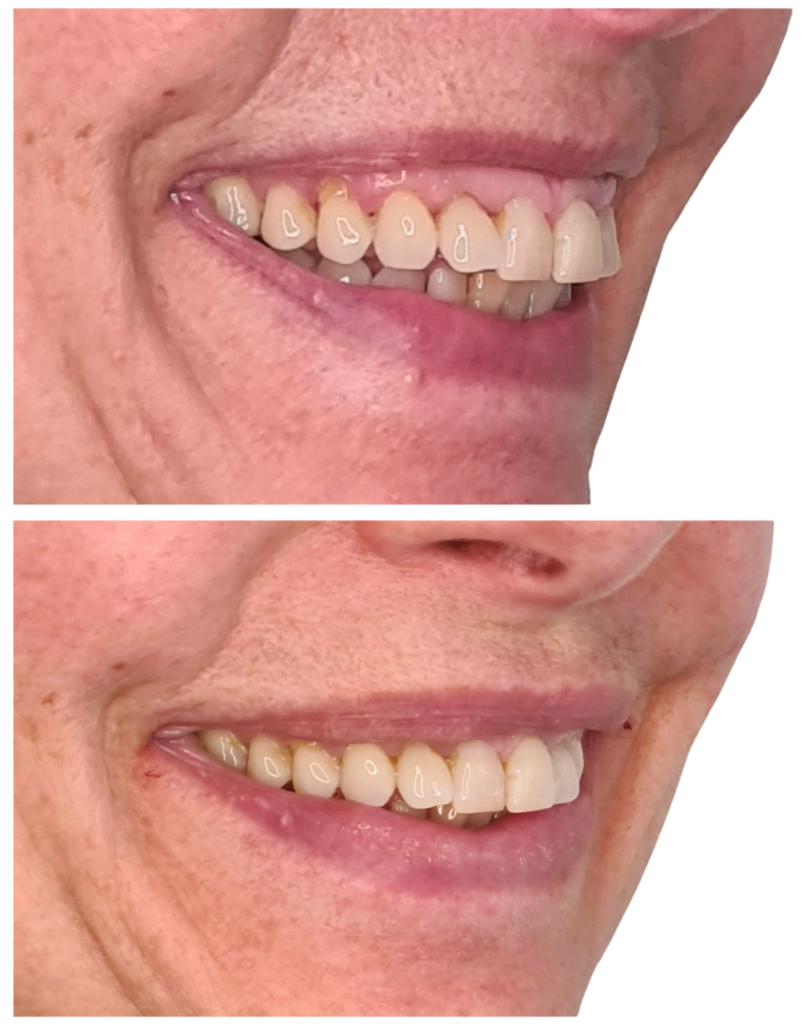 Lèvres sublimées grâce aux injections d'acide hyaluronique : obtenez de beaux résultats avec des lèvres pulpeuses, bien définies et naturelles.