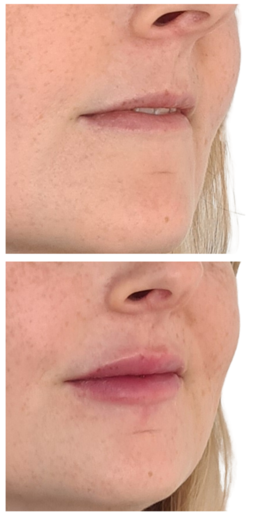 Lèvres sublimées grâce aux injections d'acide hyaluronique : obtenez de beaux résultats avec des lèvres pulpeuses, bien définies et naturelles.