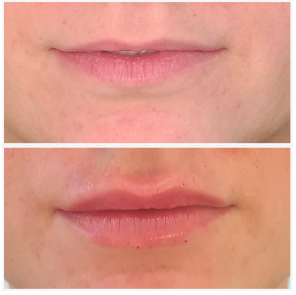 Lèvres sublimées grâce aux injections d'acide hyaluronique : obtenez de beaux résultats avec des lèvres pulpeuses, bien définies et naturelles.