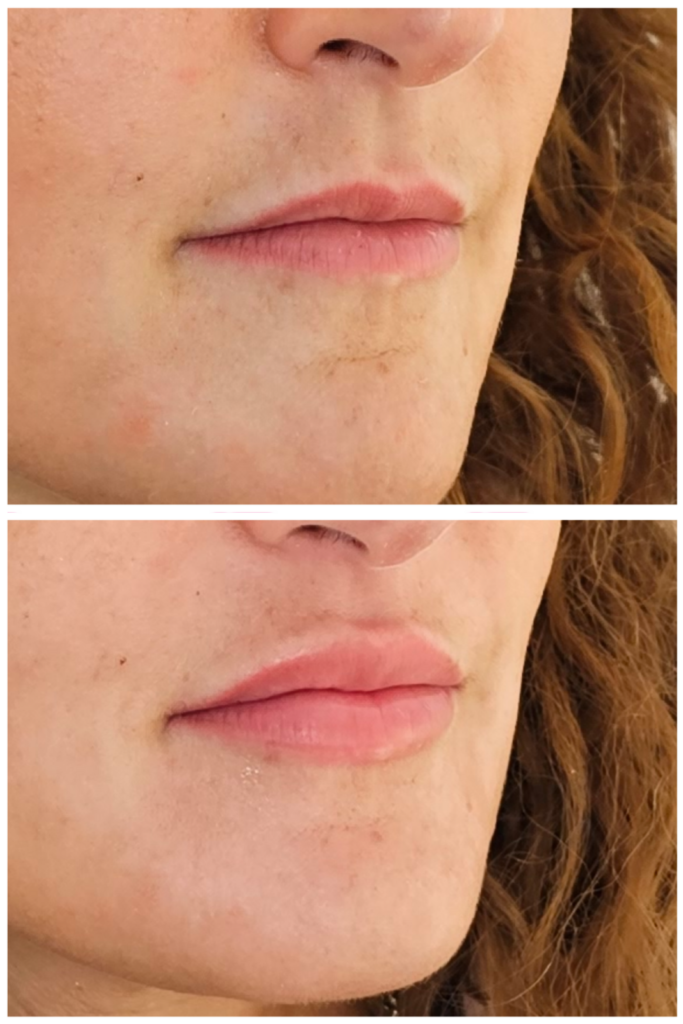 Lèvres sublimées grâce aux injections d'acide hyaluronique : obtenez de beaux résultats avec des lèvres pulpeuses, bien définies et naturelles.