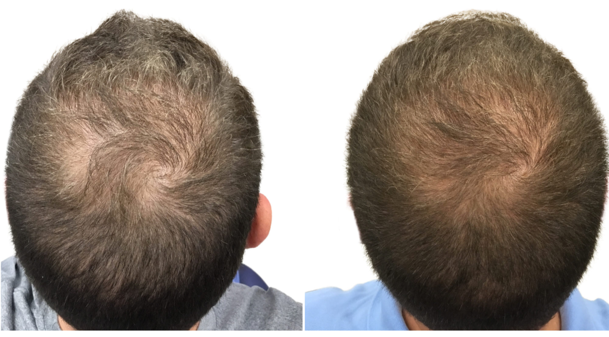 Traitement PRP pour les cheveux : stimulez la croissance capillaire et améliorez la densité des cheveux grâce à cette procédure non chirurgicale. Résultats avant après chez un homme