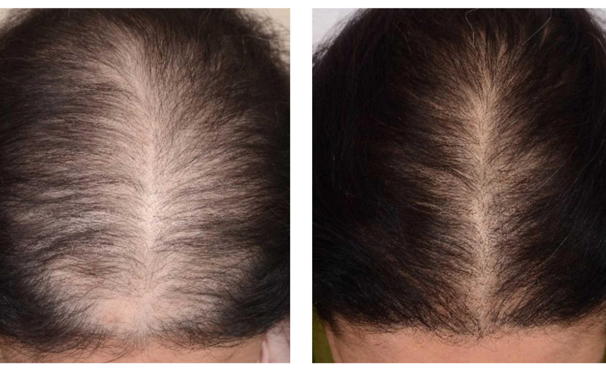 Traitement PRP pour les cheveux : stimulez la croissance capillaire et améliorez la densité des cheveux grâce à cette procédure non chirurgicale. Résultats avant après chez une femme