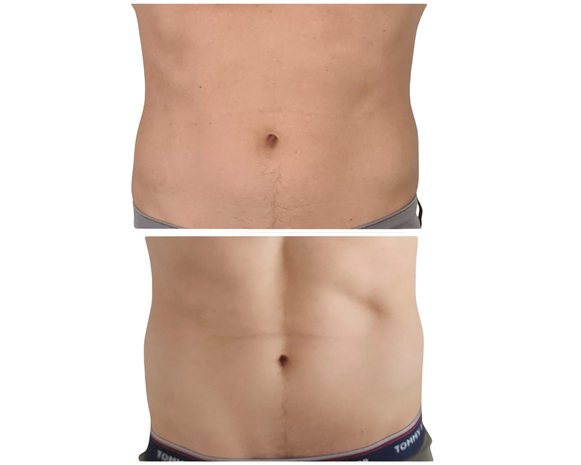 Electrostimulation musculaire à haute intensité de la zone abdominale