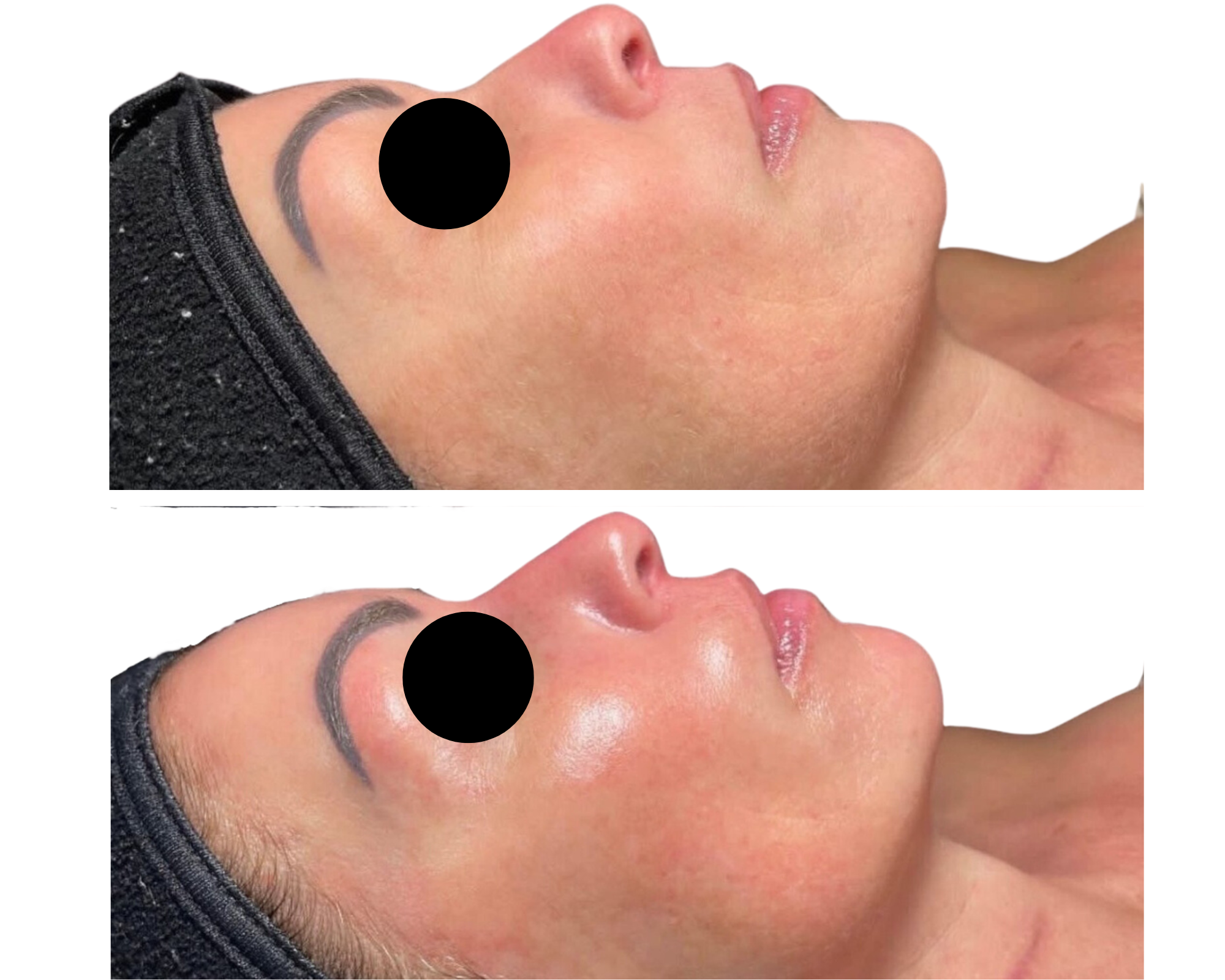Hydrafacial : soin de peau numéro un dans le peau : pour nettoyer la peau en profondeur et une hydratation intense
