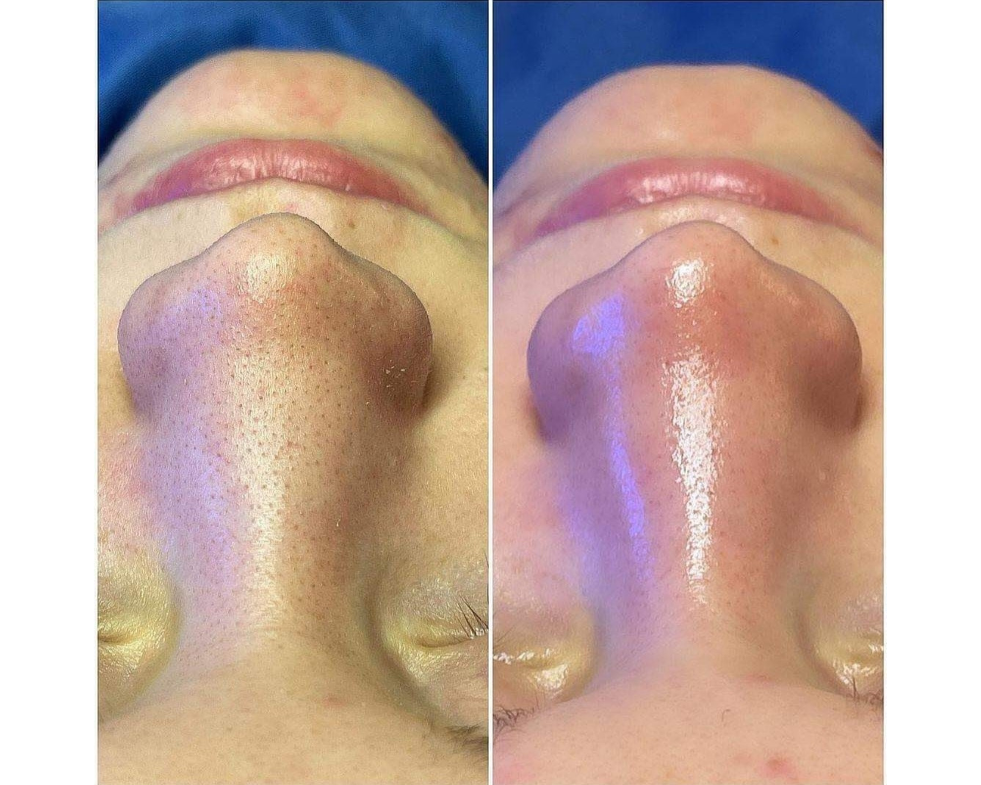 Hydrafacial : soin de peau numéro un dans le peau : pour nettoyer la peau en profondeur et une hydratation intense