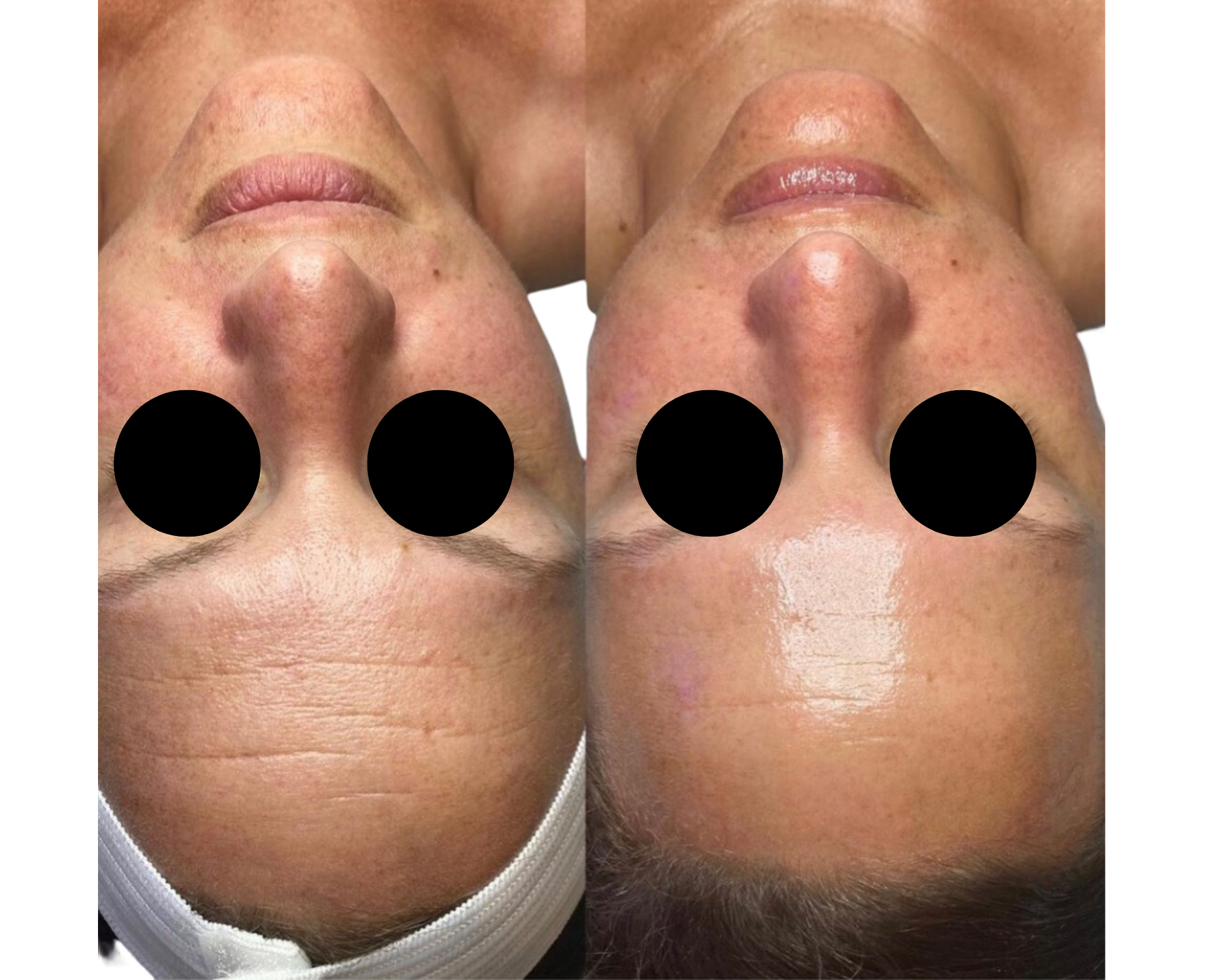 Hydrafacial : soin de peau numéro un dans le peau : pour nettoyer la peau en profondeur et une hydratation intense