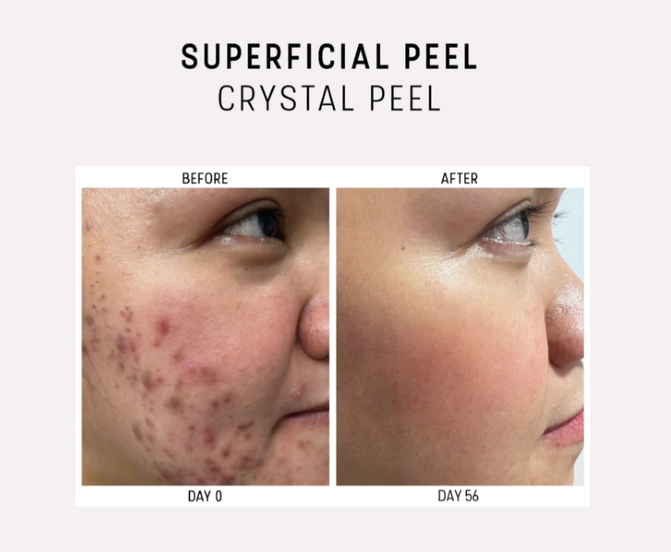 Crystal Peel est un dispositif médical classe IIa. Indiqué pour le traitement du mélasma, des lentigos solaires et séniles, de la pigmentation post-inflammatoire, de l’acné légère et de l’hyperkératose.