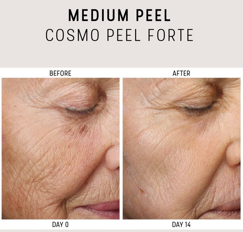 Cosmo Peel Forte est un dispositif médical classe IIa. Indiqué pour le traitement des cicatrices d’acné, des lentigo séniles et de la kératose actinique.