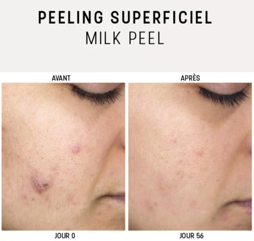 Milk Peel est un dispositif médical classe IIa. Indiqué pour le traitement de l’acné légère, de la kératose pilaire et des lésions pigmentaires superficielles.