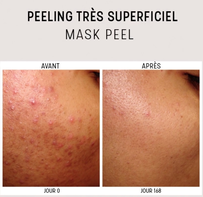 Mask Peel est un peeling cosmétique professionnel. Indiqué pour réduire l’apparence des peaux grasses et à tendance acnéiques, les pores dilatés et l’excès de sébum.