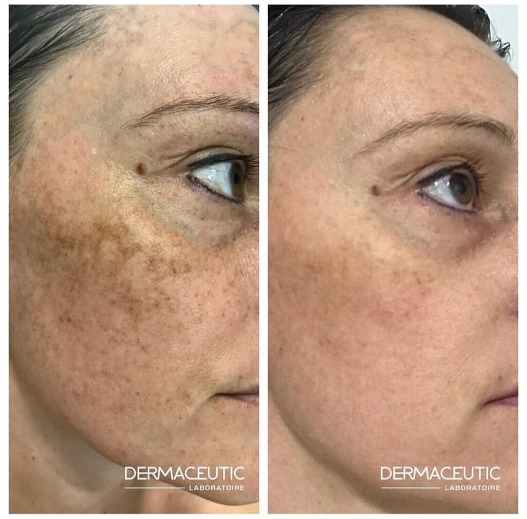 Peeling MELA PEEL FORTE dermaceutic pour traiter les tâches et mélasma