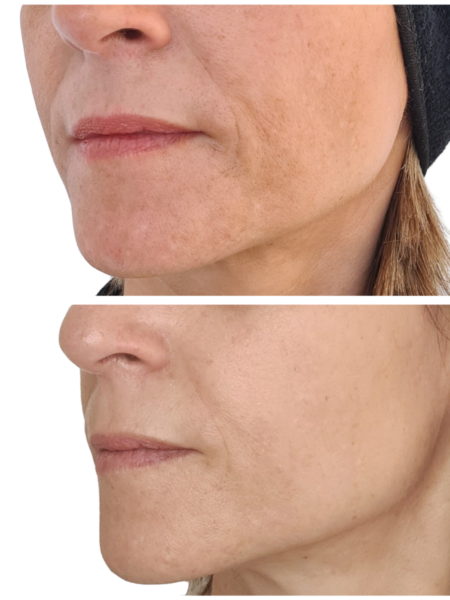 Laser origin visage tâche rides cicatrices imperfections