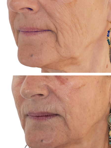 skinbooster acide hyaluronique visage